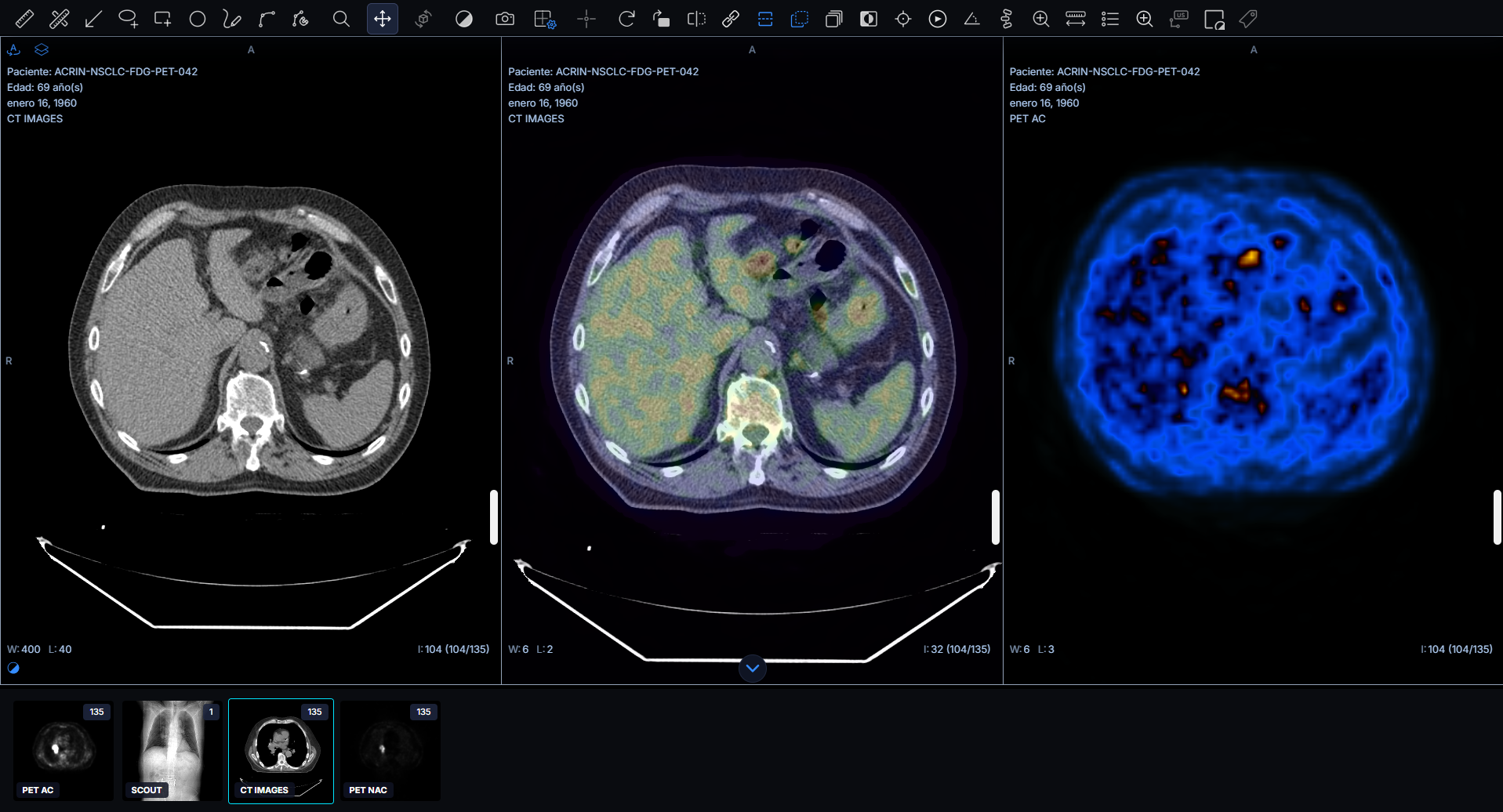 Fusión PET-CT